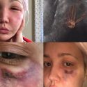 Meghan Linsey Suffers Nasty Brown Recluse Spider Bite